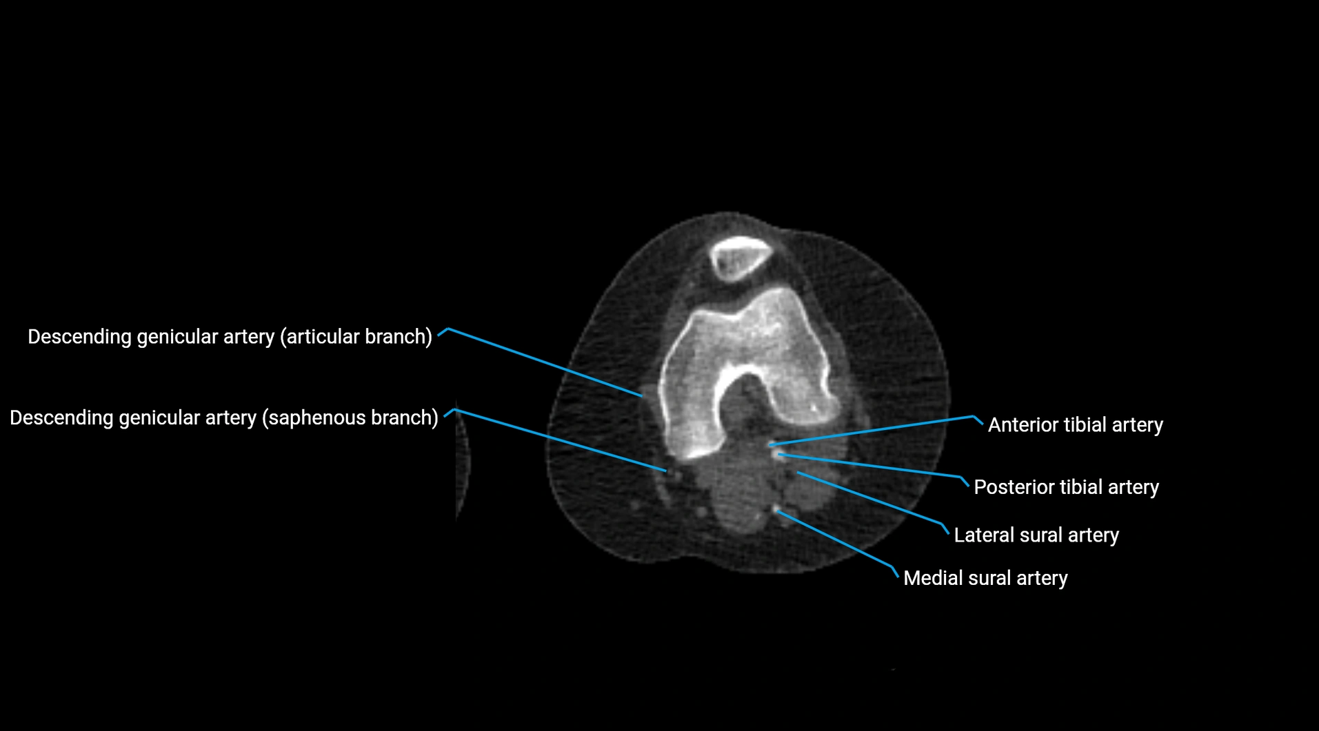 CTA lower limb cross sectional anatomy labelled image _173.webp